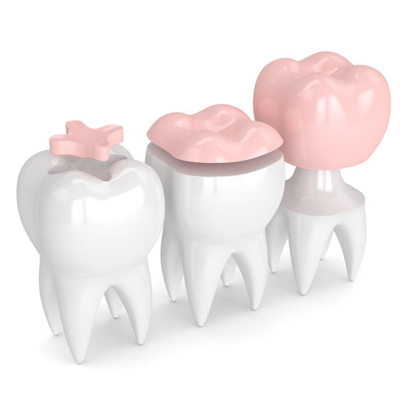 walk in Dental Crowns