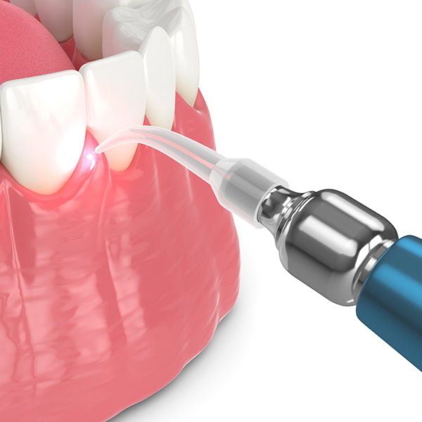 Laser Gum Disease Treatment