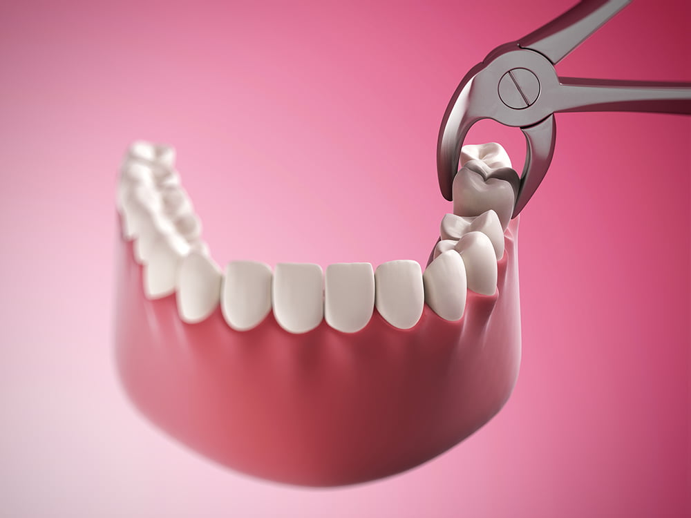 Tooth Extractions in Richardson TX