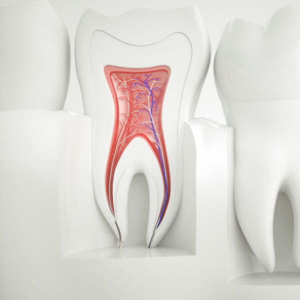 Root canal in Richardson Texas
